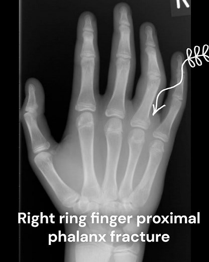 Ring finger proximal phalanx fracture