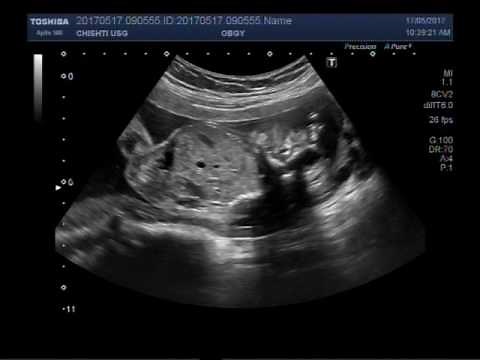 Ultrasound Video showing Anencephaly.
