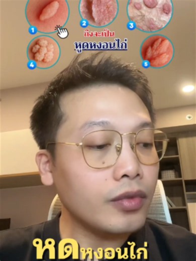 สังเกตุยังไง #หูดหงอนไก่ #โรคติดต่อ #พสพ #รักษาหูดหงอนไก่ #โรคติดต่อทางเพศสัมพัธ์ #hpv