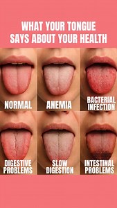 👅 Your tongue is more than just a taste buddy – it’s a health mirror! Doctors often check the tongue during routine exams because it can reveal clues about what’s happening inside your body. Here’s what different tongue appearances may signal: 1️⃣ Normal Tongue → Pink, moist, and smooth with tiny bumps (papillae). ✅ Healthy state. 2️⃣ Pale Tongue → Could indicate anemia (low hemoglobin/iron). You might feel tired, weak, or dizzy. 3️⃣ Red with patches/spots → May suggest a bacterial infection or