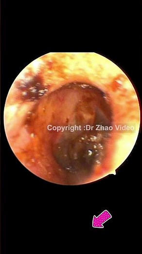 EAR WAX REMOVAL #Shorts #769