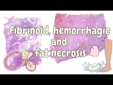 Fibrinoid, hemorrhagic and fat necrosis - general pathology
