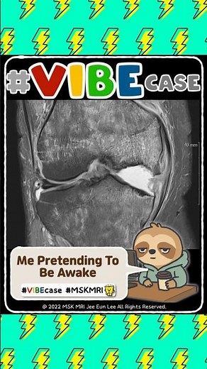 [VIBEcase] Subchondral Insufficiency Fracture of the Knee (SIFK):