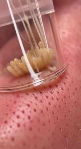 This Is The BEST Pore Vacuum I've EVER Used! Watch It Clear My Clogged Pores!