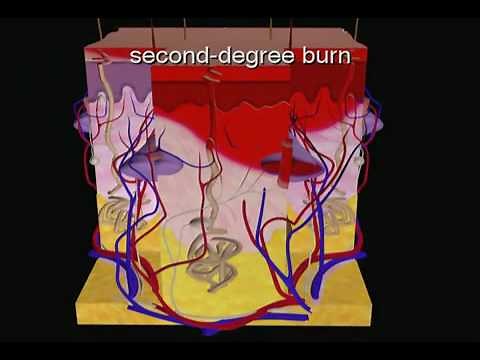 Types of Burns - First_ Second_ and Third-Degree Burns Video.flv