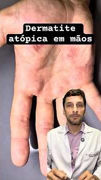 Atopic dermatitis on the hands. 🙌 How to treat it? ⁉️ #dermatitis #eczema #atopicdermatitis