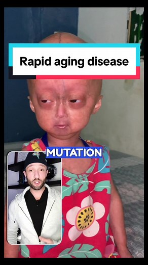 Understanding Progeria Syndrome: Causes, Symptoms, and Treatments