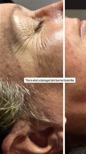 Deep wrinkles aren’t aging — they’re a broken barrier. We can fix this. 👇#over50skincare