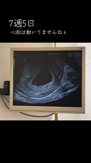 高齢妊婦健診の重要性と心拍確認のポイント