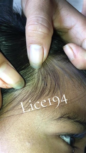 Remove lice #😂😂😂 #😭😭😭 #lice😰😰😰 #😱😱😱 #liceremoval