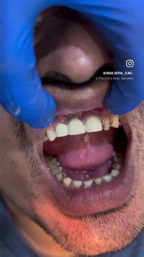 Feeling fabulous with my capped front teeth #smiledesigndental #crowndental #teethdecay #smilebrilli