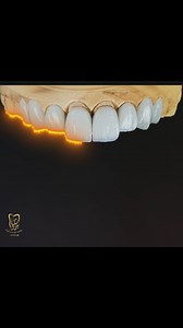تصميم Emax premium veneer يليق بحضورك Every detail is crafted to elevate your presence With Emax premium veneers By #prettau_dental_lab #dubaidental #premium #veneers #details #emax #dubai | Prettau Premium
