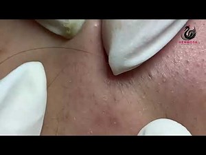 Unbelievably Relaxing Pimple Popping Session | Hermosa AcneAway SPA | 4K Video