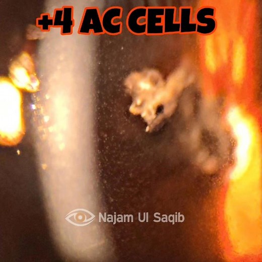 Anterior Chamber cells ++++ and Flare seen on Slit Lamp Examination by the 'Tyndall Effect'.