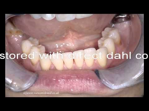 Upper Occlusal (Michigan) Splint for treatment of Facial Athromyalgia