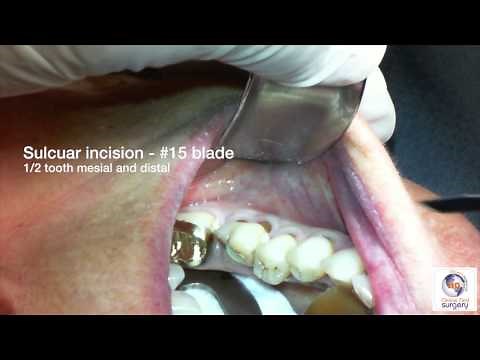 Extraction of Tooth #19 with Ridge Preservation Grafting