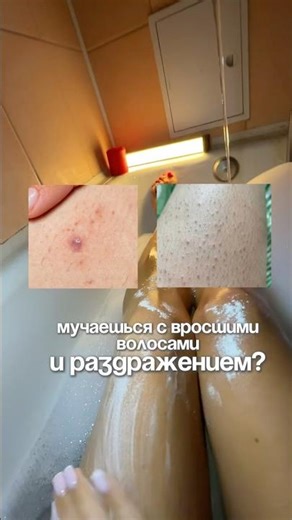 Арт.WB: #WW161592 (копируй с буквами WW) Вросшие волосы РП