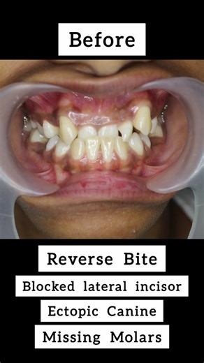 Fahim Momin on Instagram: "Reverse Overjet ! Hello everyone ! Sharing today one of my marvellous case. This young lady visited my clinic last year by keeping a track of my reels on Instagram. She had very crooked teeth, blocked lateral incisor, reverse overjet, several decayed molars, etc. This was one of my toughest case to treat. With proper treatment planning, precise orthodontics and skillful hands, the results are before you ! Patient satisfaction is ultimate joy ! How would you rate this t
