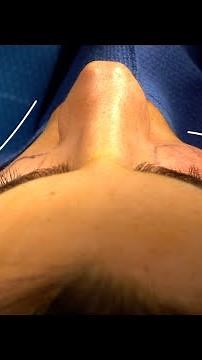 Combining Fat Transfer with Lower Blepharoplasty | Trifecta Lift with Dr. Parsa