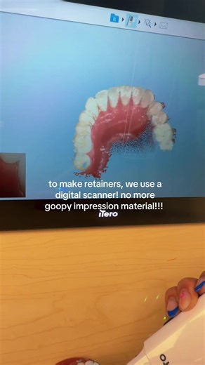 Three Essential Retainer Facts for Better Oral Care