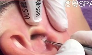 Blackhead Removal Videos on Instagram: "Link in Bio @blackheadvids 👈😱 FOR MORE VIDEOS, LINK IN BIO. . . #blackheadextraction #pimple #pimplepop #pimplepoppers #whitehead #pimples #pimplepopping #whiteheadextraction #blackheadremoval #blackheadtweezers #pimplepopper #whiteheads #blackheads #blackhead #drpimplepopper #cystremoval #drsandralee #whiteheadremoval #pimplesremover #pimpleextractor #pimplelife #hardpopclub"