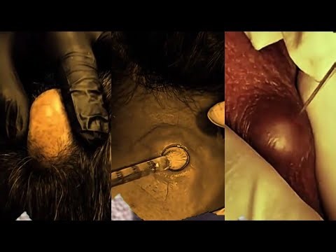 Satisfying Pimple Popping ASMR — Huge Zit & Blackhead Removal | 036