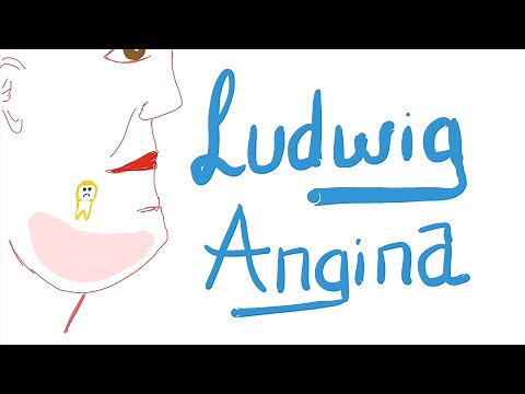 Ludwig Angina | 🚑 | Causes, Clinical Picture, Diagnosis and Management