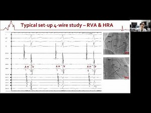 Understanding of intracardial signals in electrophysiological study