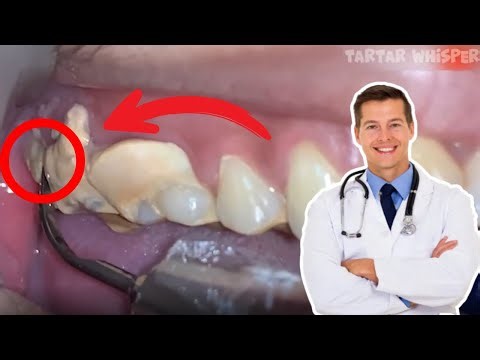 20-Minute Half-Jaw Deep Cleaning