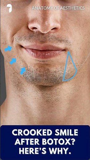 Crooked Smile After Botox? Here's How We Can Fix It | Anatomy of Aesthetics
