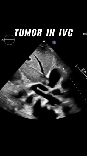 Renal cell carcinoma (RCC) on echocardiography typically presents as a mobile, often pedunculated, hyperechoic mass extending from the inferior vena cava (IVC) into the right atrium (RA) 📖 Advance your adult echocardiography expertise with weekly case breakdowns aligned with current guidelines to improve your scanning and reporting ⬇️ Join the newsletter 💌 Link is in our Instagram bio 🫀