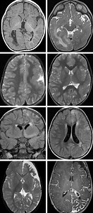 Peri-insular Hemispherotomy | Cohen Collection | Volumes | The Neurosurgical Atlas