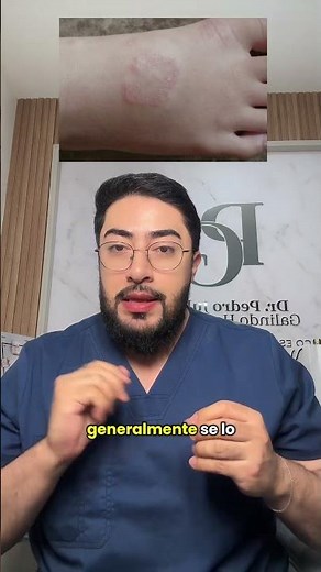 Granuloma anular centrífugo #dermatologia #skincare #piel #granulomaanular