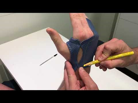 Metacarpal fracture brace by ATS