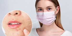 Masks are the new acne: What you need to know about them and how to prevent them!