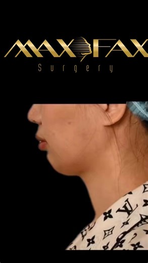 ‎دكتور معن الخطيب‎ on Instagram‎: "جراحة الوجه و الفكين بتقنية ماكس فاكس الحصرية للدكتور معن الخطيب✨ “إجراء طبي دقيق مع تقنية الماكس فاكس يهدف إلى تحسين تناسق الوجه وتوازن الفك 💎 ليمنحك نتائج طبيعية ✨” ⚜️Max Fax Surgery⚜️- Jaw and Chin repositioning ✨ “A precise medical procedure with MaxFax technique aimed at enhancing facial harmony and jaw balance 💎 to deliver natural and elegant results ✨”. #foryou #fyp #اكسبلور_explore #maxfax #dxb"‎