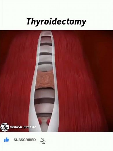 Thyroidectomy or Thyroid Removal Surgery 💉💊🩹🩺