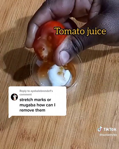 Natural Home Remedies for Stretch Marks Removal