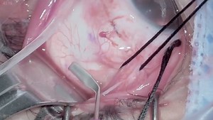 Heads-Up Sutureless Chandelier-Assisted Scleral Buckle - Eyetube