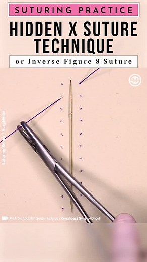 Hidden X Suture Technique also known as Inverse Figure 8 Suture Technique. This method offers both anesthetic advantages and provides hemodynamic stability and precise skin edge approximation, similar to the standard figure of eight suture. #training #medical #suture #medicina #surgery | SurgMedia