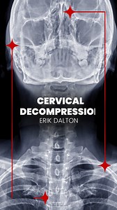 11K views · 227 reactions | Cervical Decompression Technique In...