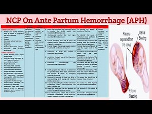 NCP 29 Nursing Care Plan on Ante Partum Hemorrhage (APH)