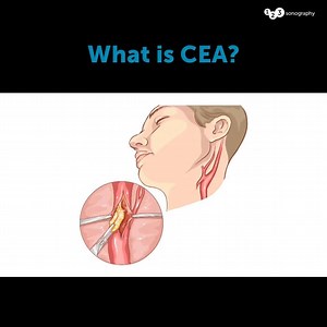 3.3K views · 27 reactions | What is CEA? Carotid endarterectomy is a...