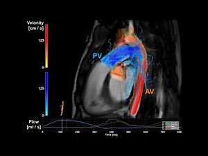 4D flow MRI visualization of pulmonary and aortic valve insufficiency