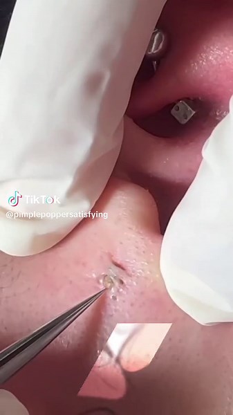 pimplepoppersatisfying su TikTok