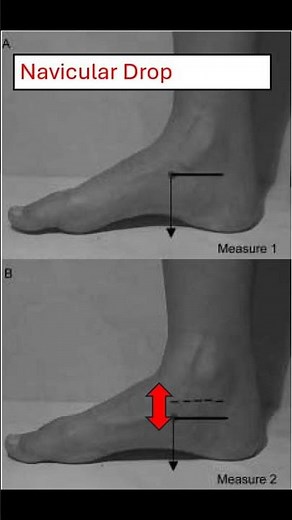 🔍 Navicular Drop Test Explained: Quick Foot Assessment 🦶 #footpain #meded #physio #podiatry #ortho