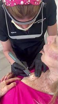 Plasma Pen precisely and efficiently removes Seborrheic Keratoses