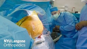 Staged Hip Arthroscopy with Labral Reconstruction Followed by Femoral Derotation Osteotomy