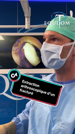 Extraction arthroscopique d’un fracturé 💙 Comme promis dans notre précédente publication, voici des nouvelles du poulain admis en urgence pour un jarret fortement enflé. Les radiographies ont révélé une fracture déplacée de la crête trochléaire latérale du talus, une blessure que nous rencontrons fréquemment chez les jeunes poulains suite à un traumatisme. Bien que ces poulains ne présentent pas toujours une boiterie marquée, une distension synoviale de l’articulation est souvent clairement vis