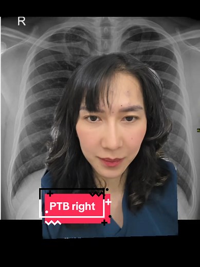 X-Ray Interpretation of PTB: Understanding Results